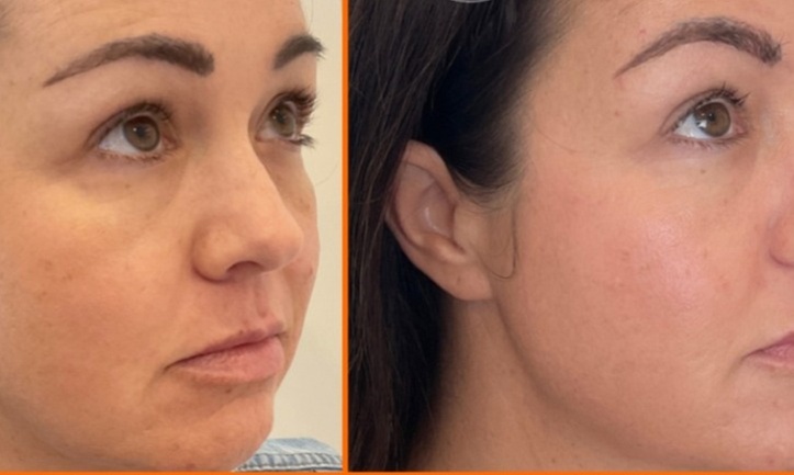 Boost Your Glow with Natural PRF Treatments