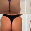 Image 2: Up to 57% Off on Injection Sculptra at Age Well Dr Labs