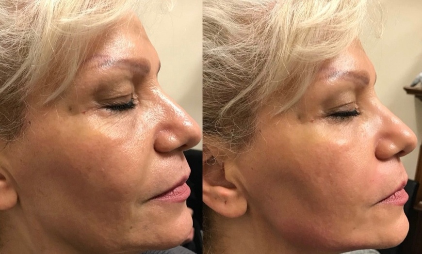 Image 3: Enhance Natural Beauty with Expert Dermal Filler Injections(0.5ml–2ml)