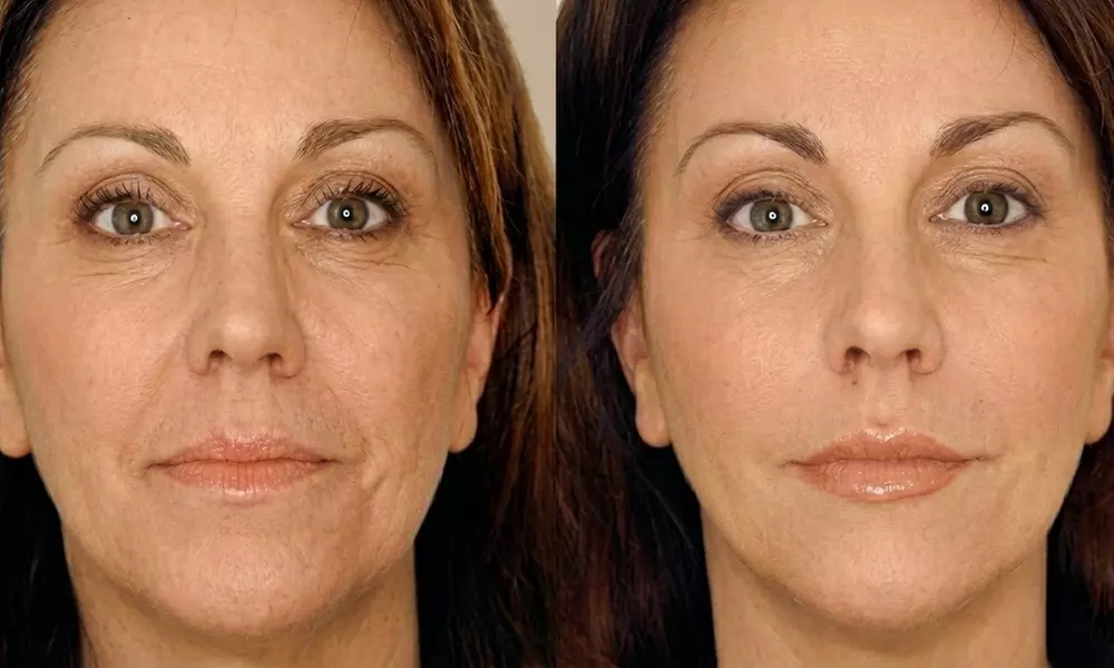 Non Surgical Face Lift w/w/o Advanced Skin Tightening & Jawline Sculpting at Your Sculpt Studio (Up to 50% Off)