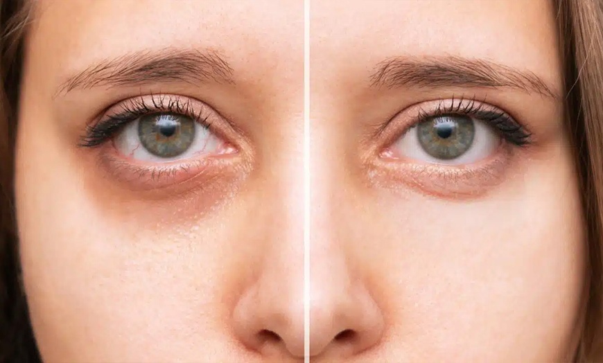 Image 1: Up to 45% Off on Dark Circle / Under Eye Treatment at Dermathetics