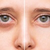 Image 1: Up to 45% Off on Dark Circle / Under Eye Treatment at Dermathetics