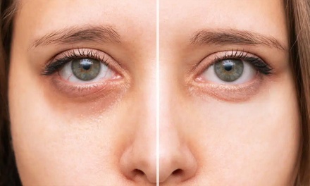 1 session - Tixel2 Blepharoplasty – Eye Rejuvenation - Dermathetics