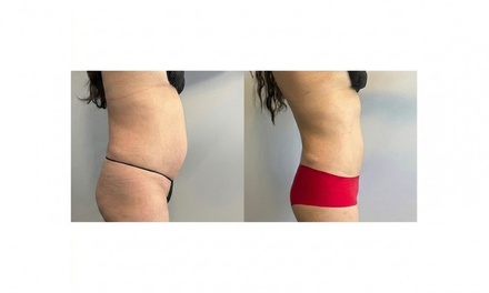 1 body contouring session - Body By Jewelz