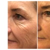 Image 2: HIFU Facial Treatments: Foxy Eyes, Double Chin, Neck & Lower Face
