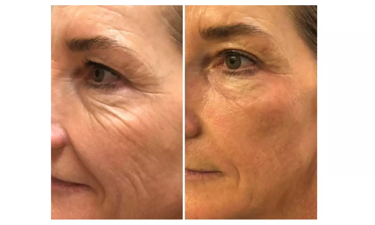 HIFU Facial Treatments: Foxy Eyes, Double Chin, Neck & Lower Face