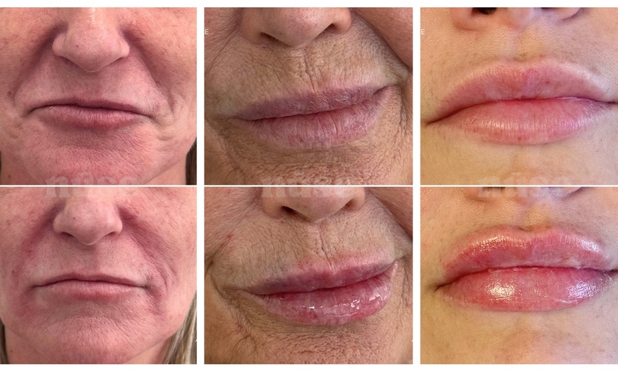 Image 2: Dermal Fillers for Lips, Nasolabial & Marionette Lines 