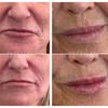 Image 2: Dermal Fillers for Lips, Nasolabial & Marionette Lines 