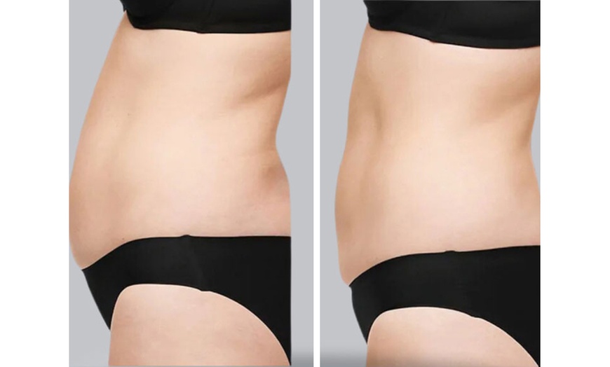 Image 2: Up to 40% Off on CoolSculpting at Freeze The Fat