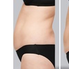 Image 2: Up to 40% Off on CoolSculpting at Freeze The Fat
