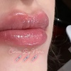 Image 1: Restylane, Sculptra, Radiesse and Kysse for a Fresh Look