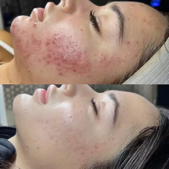 One or Two Laser Skin Resurfacing Treatments