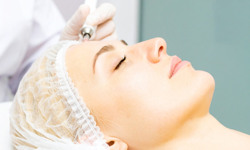 Image 1: Refresh Your Skin with One, Two or Three Micro-Needling Sessions