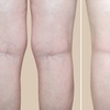 Image 3: Effective spider vein removal with two or four treatment sessions