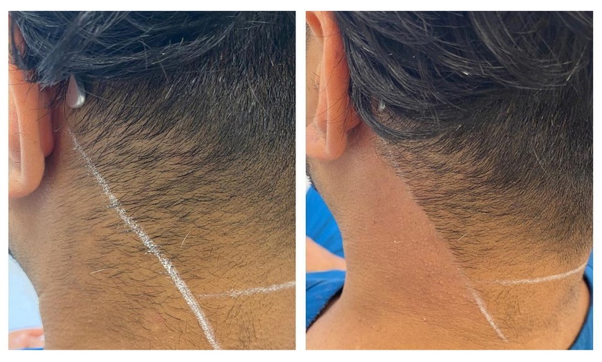 Image 3: 6 Sessions of Aerolase® Neo Elite Laser Hair Removal 