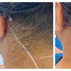 Image 3: 6 Sessions of Aerolase® Neo Elite Laser Hair Removal 
