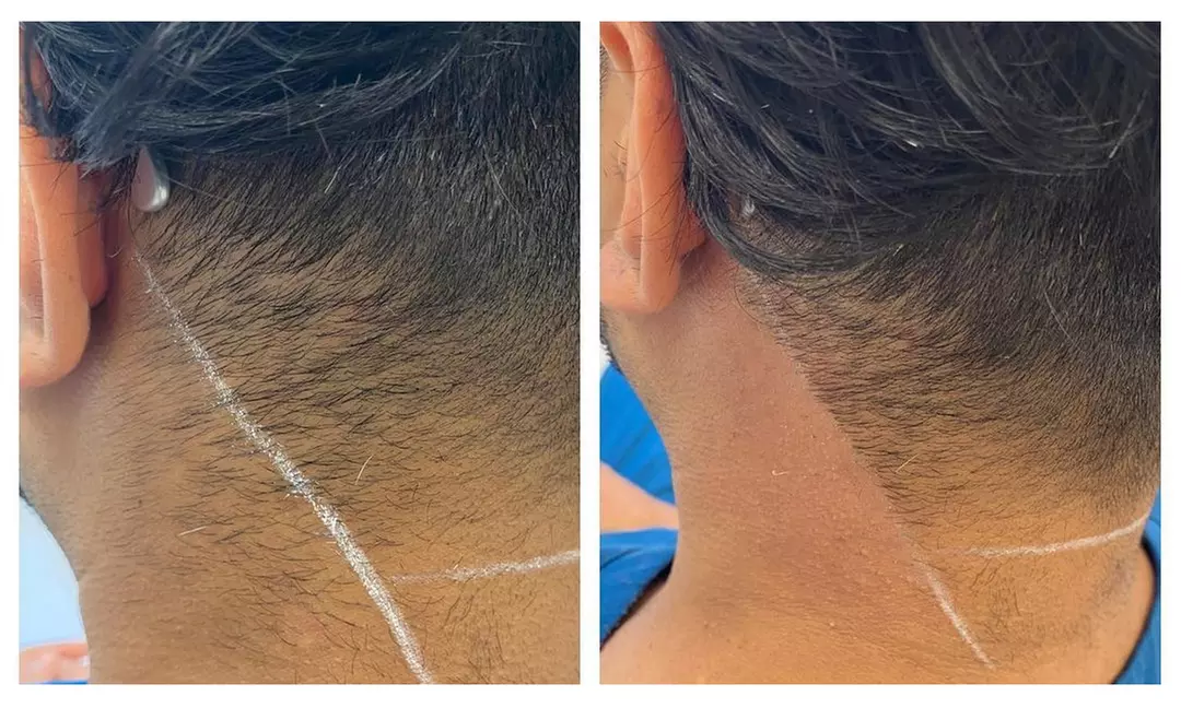 6 Sessions of Aerolase® Neo Elite Laser Hair Removal 