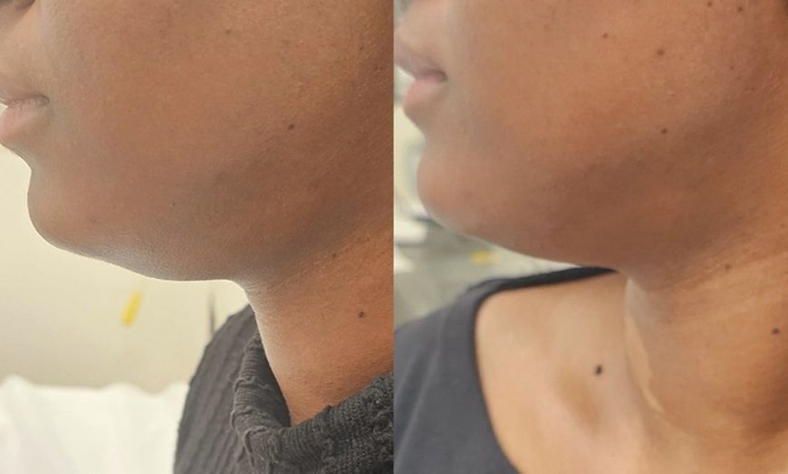 Image 3: Targeted Fat Reduction with One or Two Vials of Kybella