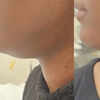 Image 3: Targeted Fat Reduction with One or Two Vials of Kybella