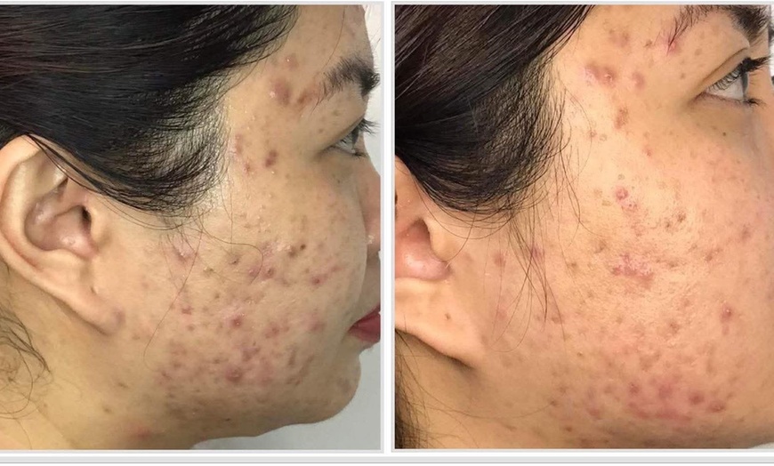 Image 7: One, Two or Three 60-Minute Signature Facials with Chemical Peels