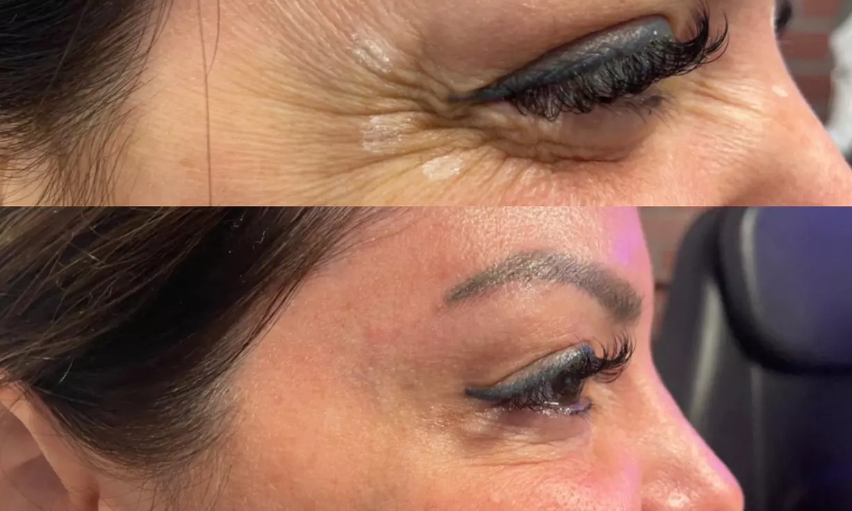 Revitalize with 20, 40, or 60 units Units of Jeuveau