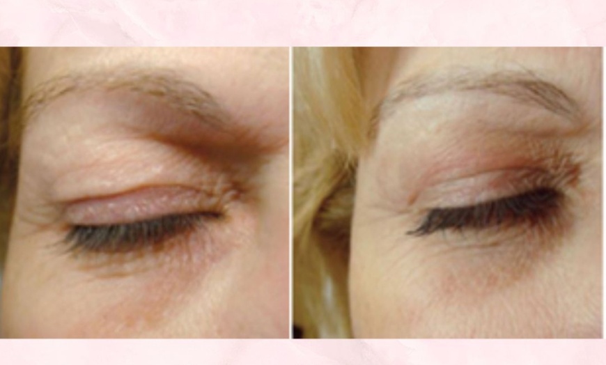 Image 3: PlexR: huidverstrakking zonder snijden