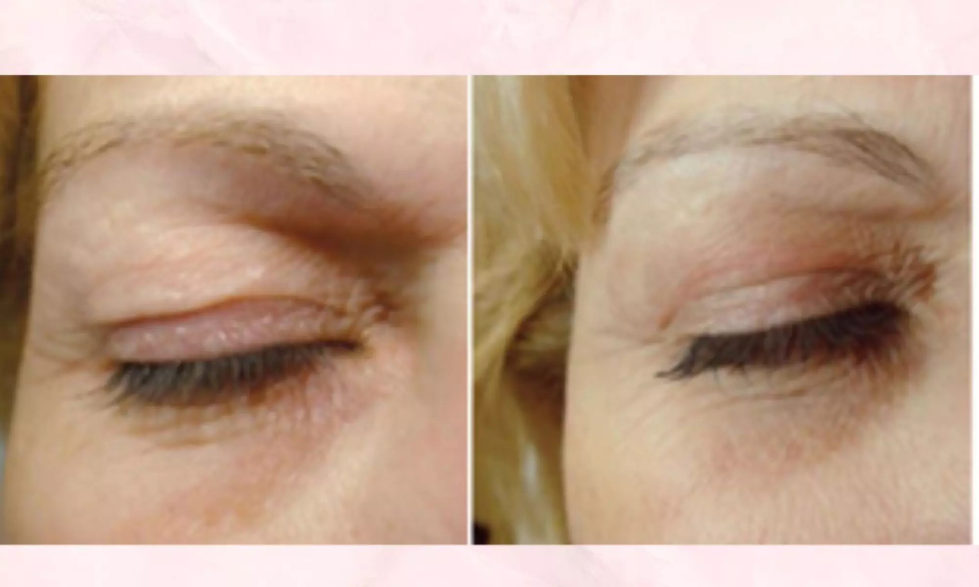 PlexR: huidverstrakking zonder snijden