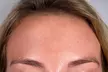 Up to 21% Off 20, 30, or 40 Units of Botox at Celebrity Smiles Aesthetic Institute - Second Medium