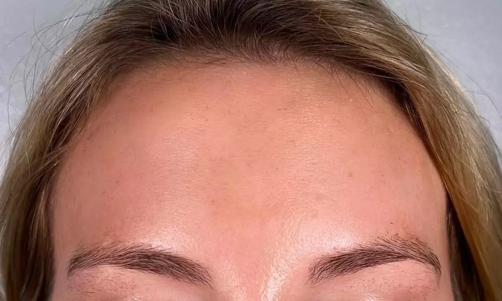 Enhance Your Look with 20, 30, or 40 Units of Botox