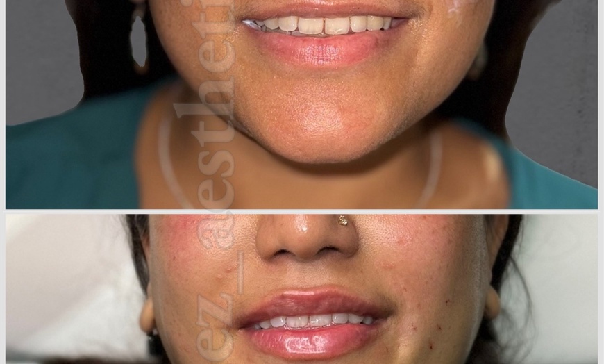 Image 3: Up to 57% Off on Injection - Dermal Filler at Diez Anti-aging Aesthetics