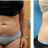 Image 1: Transform Your Body w/ 2, 4 or 6 Ultrasonic Fat & Cellulite Treatments