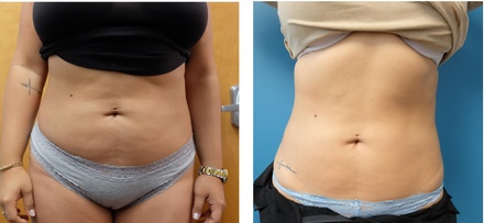 Two Ultrasonic Fat and Cellulite treatments - B Fit B Young