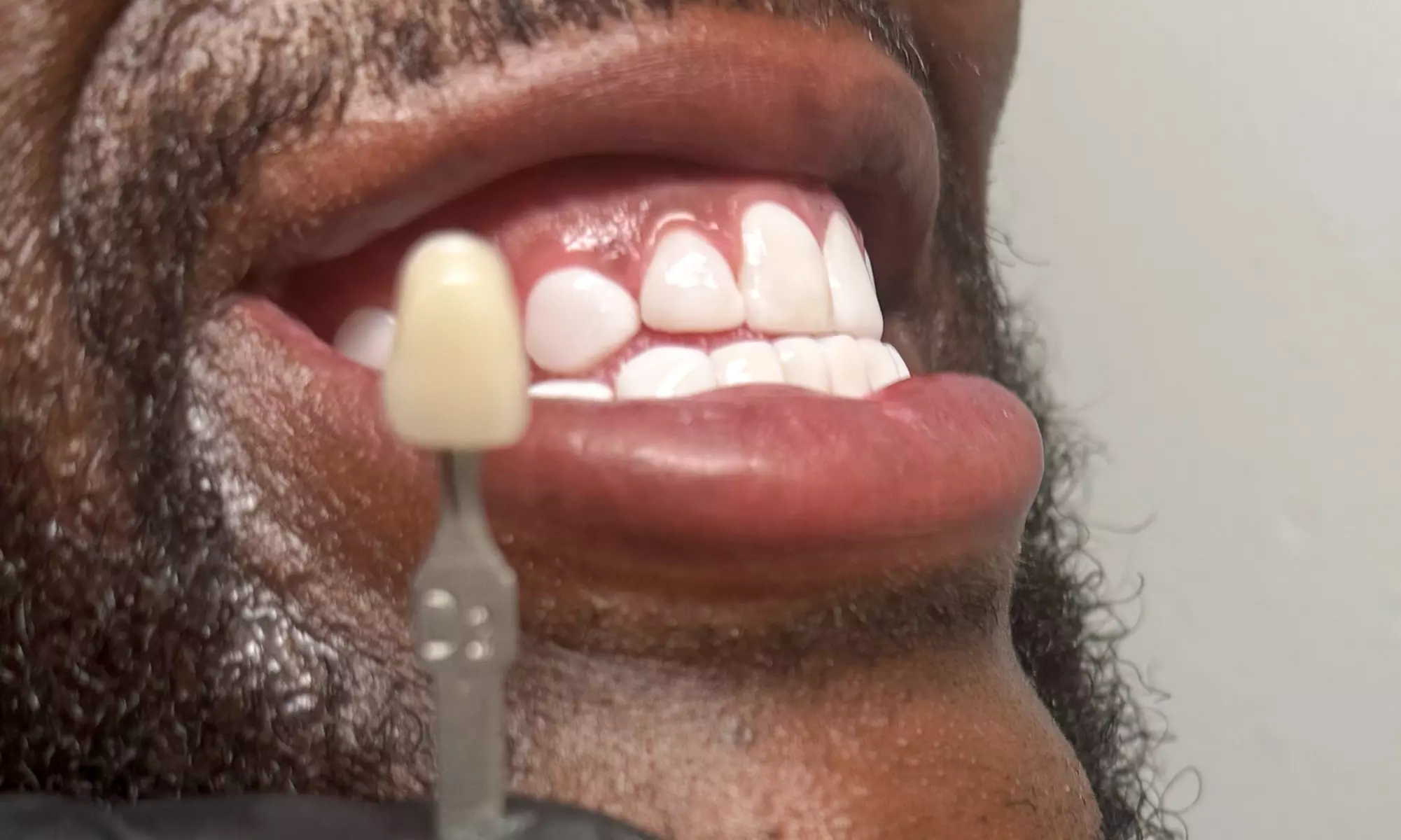 Tooth Gem Sparkle Application, Single or Double Tooth Gem and More