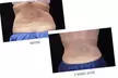Complete 5-Month CoolSculpting Program Treatments for One at Elite Skin Studio's  - Up to 55% Off - Second Medium