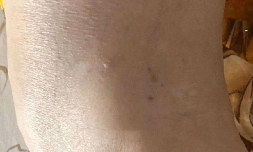 Image 2: Get Spider Vein Treatment for a 2x2 or 4x4 Area