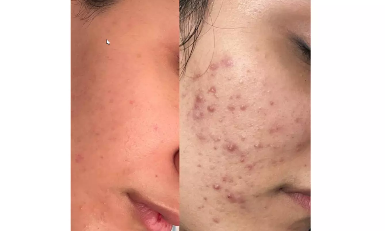 Luxury 1,2 or 3 60-Minute Chemical Peel or Signature Facials