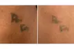 Undo the Ink with Three Tattoo Removal Sessions on an Area Up to 2x2, 3x3 or 4x4 Inches ( Up to 51% Off ) - Second Medium