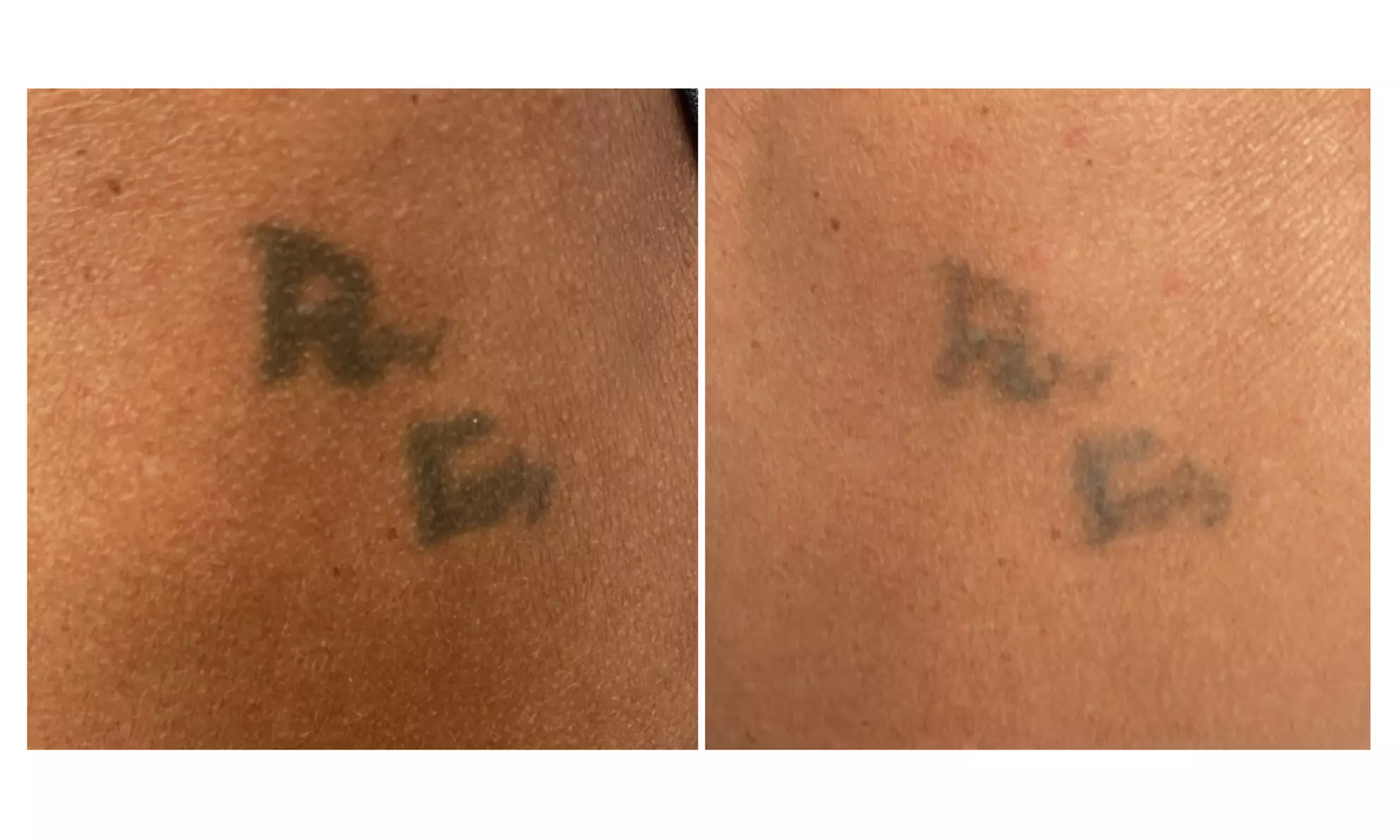 Three Tattoo Removal Sessions on an Area Up to 2x2, 3x3 or 4x4 Inches
