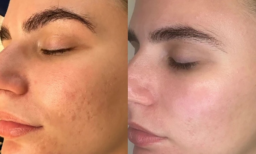 Image 4: Exosome Microneedling Packages – Choose One, Three, or Six Sessions