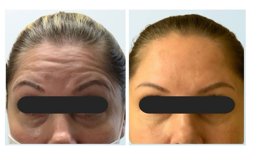 Image 6: Transform your Look with 20,40, or 60 Units of Xeomin 