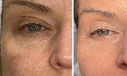 Fibroblast for Frown Lines - Par Laser