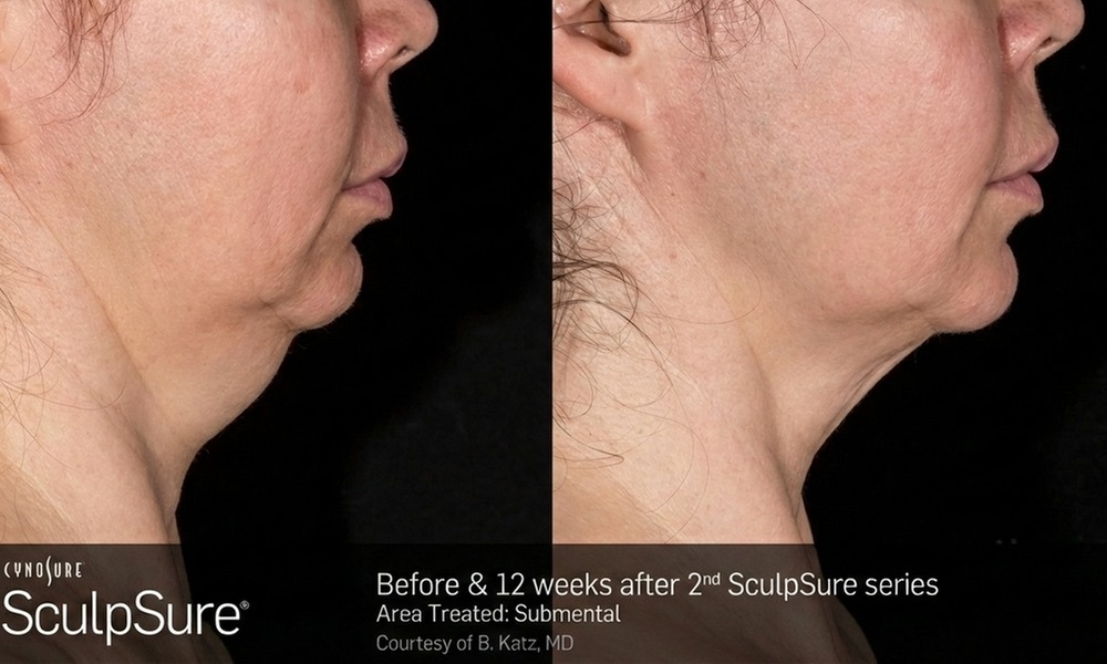 Get 1, or 2 Treated Once/Twice Laser Lipo Session