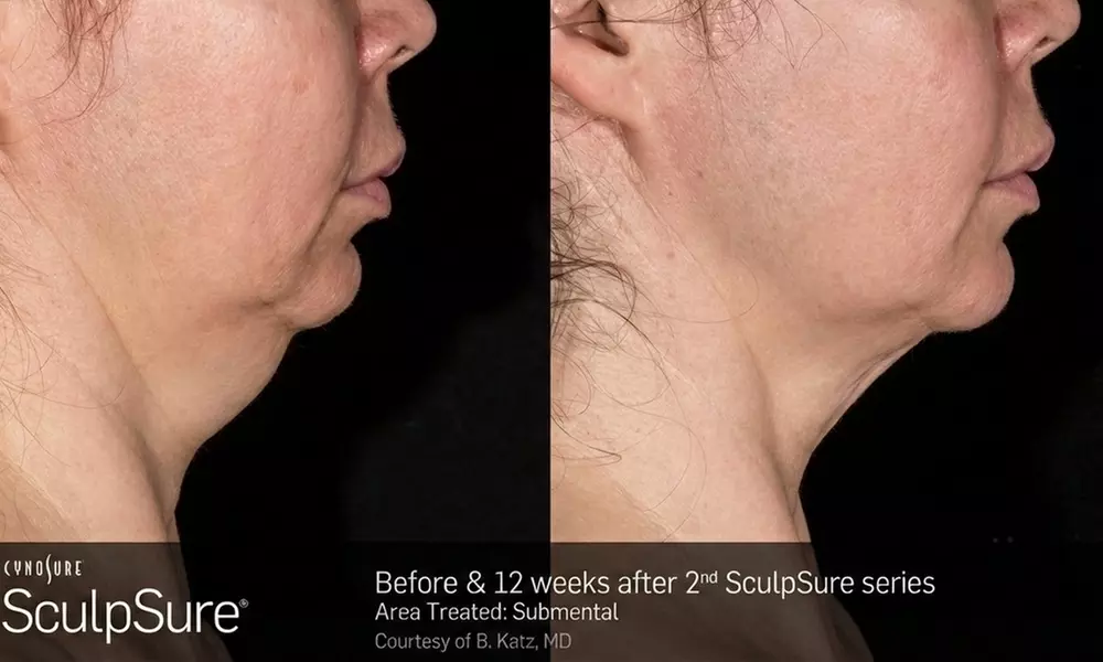 Get 1, or 2 Treated Once/Twice Laser Lipo Session at Dr. Rick A. Carpenter - Up to 35% Off - Primary Image