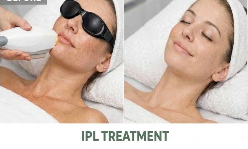 Image 2: IPL Photofacial Treatments for Pigmentation and Redness