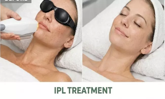 IPL Photofacial Treatments for Pigmentation and Redness