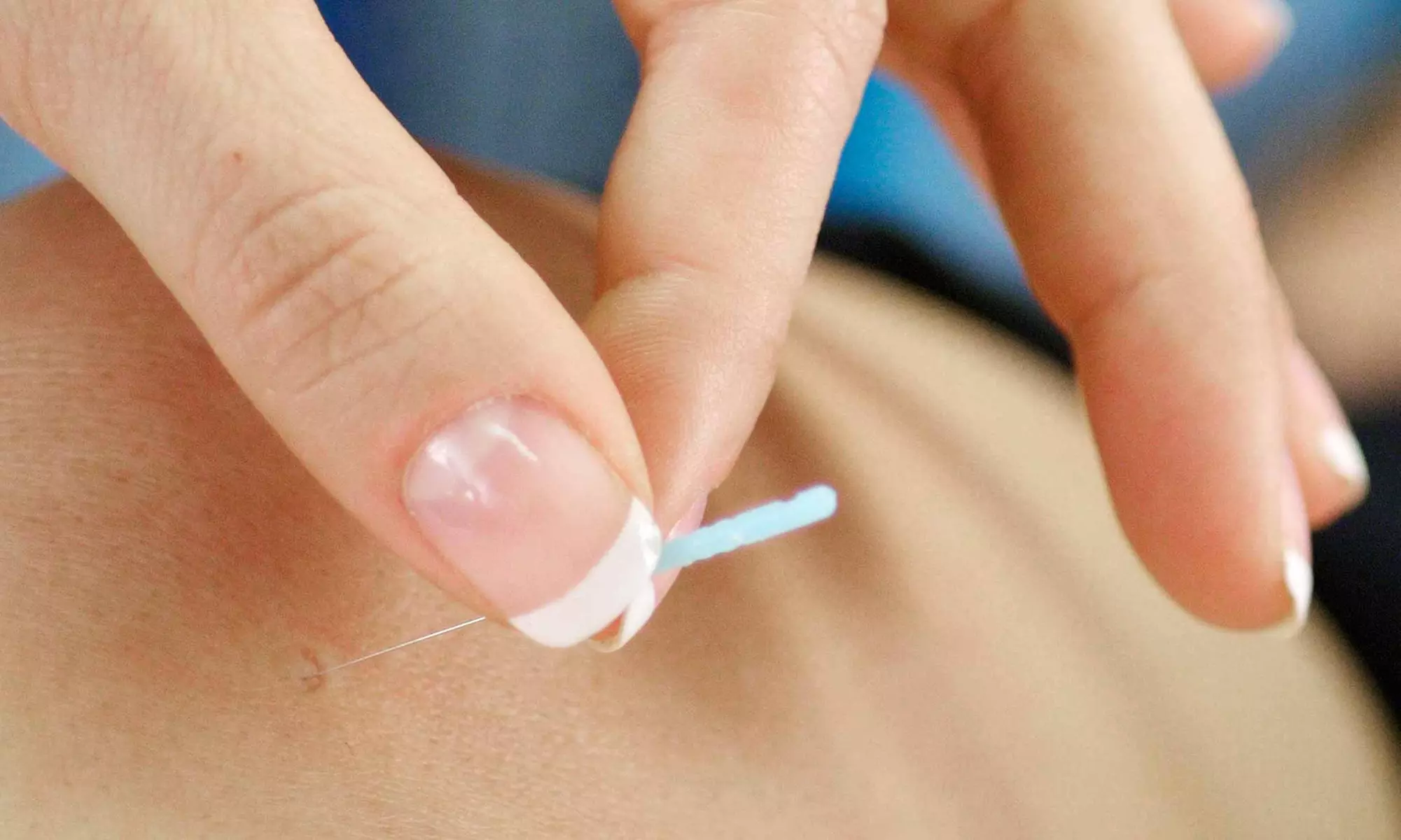 Acupuncture with Cupping or Facial Massage at Complete Balance Acupuncture & Wellness Clinic (Up to 69% Off) - Primary Image