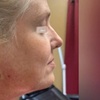 Image 2: Up to 35% Off on Facelift - Thread Lift at Amy Speer PAC at Rejuvenation Wellness