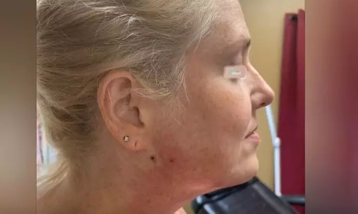 Up to 35% Off on Facelift - Thread Lift at Amy Speer PAC at Rejuvenation Wellness
