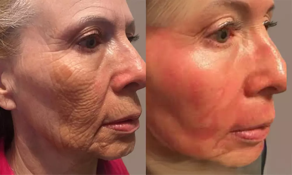 CO2 Laser Treatment for Scars & Tightening or Face, Neck & Décolletage