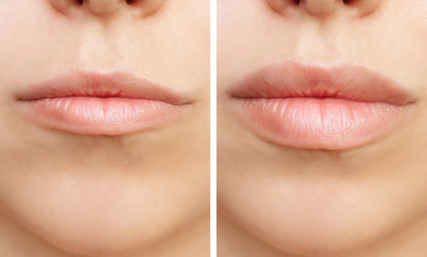 Image 1: Achieve Plump Lips with 1ml or 2ml Dermal Fillers  